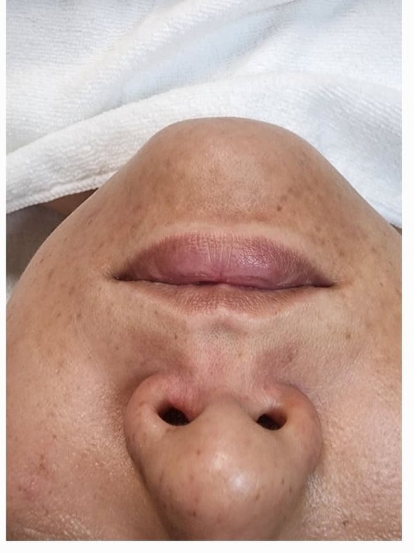 Pigmentation — After