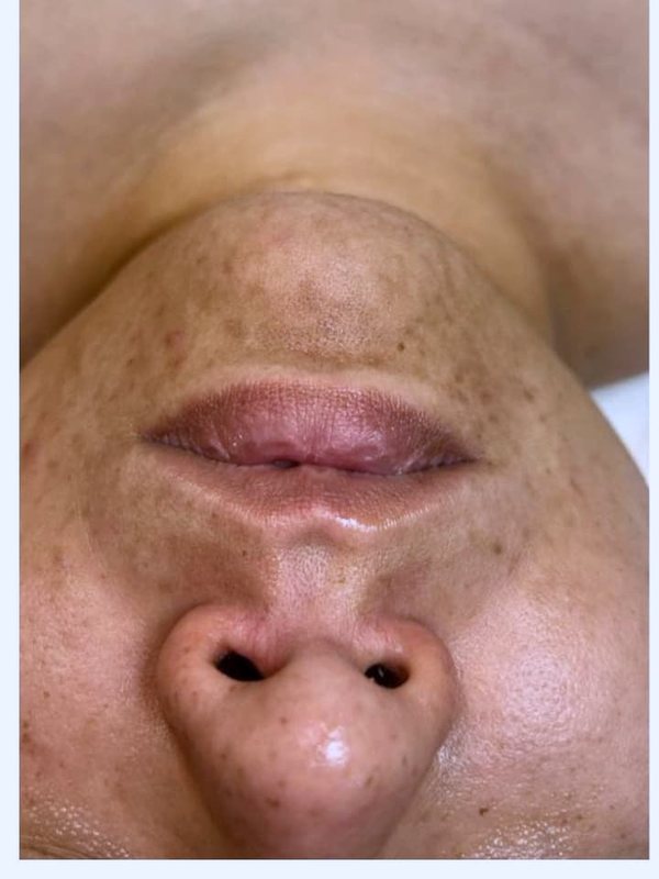 Pigmentation — Before